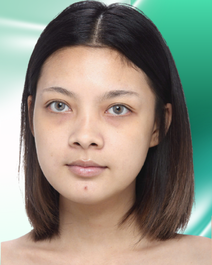 Ảnh trước nâng mũi