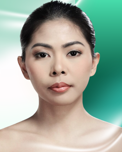 Ảnh trước nâng mũi