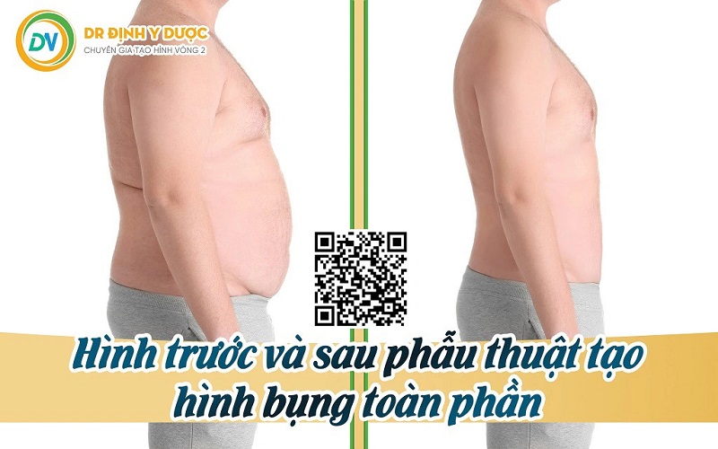 Hình trước và sau phẫu thuật tạo hình thành bụng toàn phần