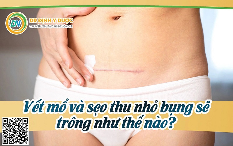 Vết mổ và sẹo thu nhỏ bụng sẽ trông như thế nào?