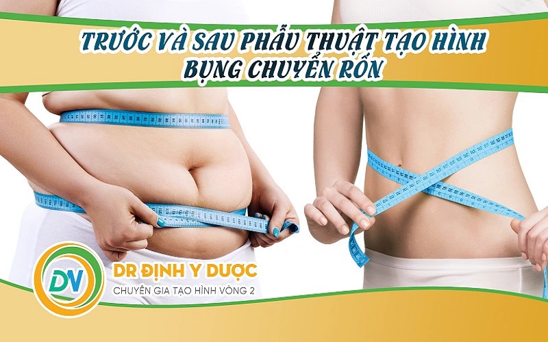 Tạo hình thành bụng chuyển rốn