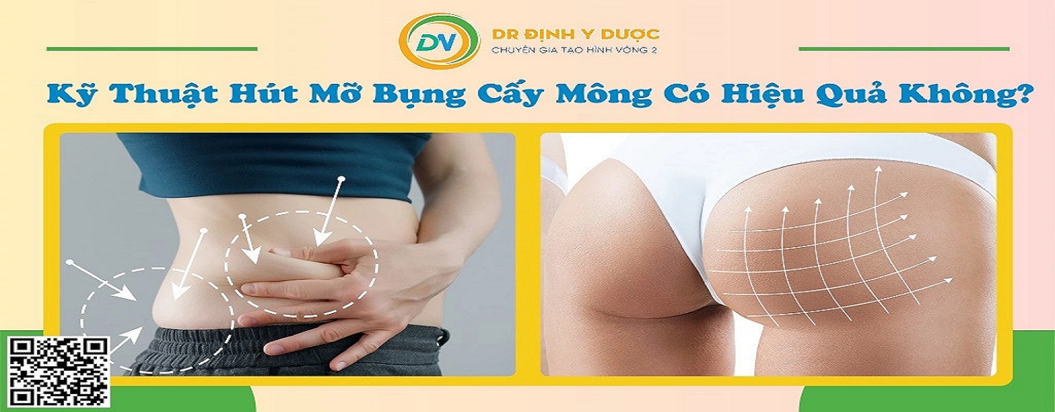 Kỹ Thuật Hút Mỡ Bụng: Phương Pháp Giảm Mỡ Hiệu Quả Và An Toàn