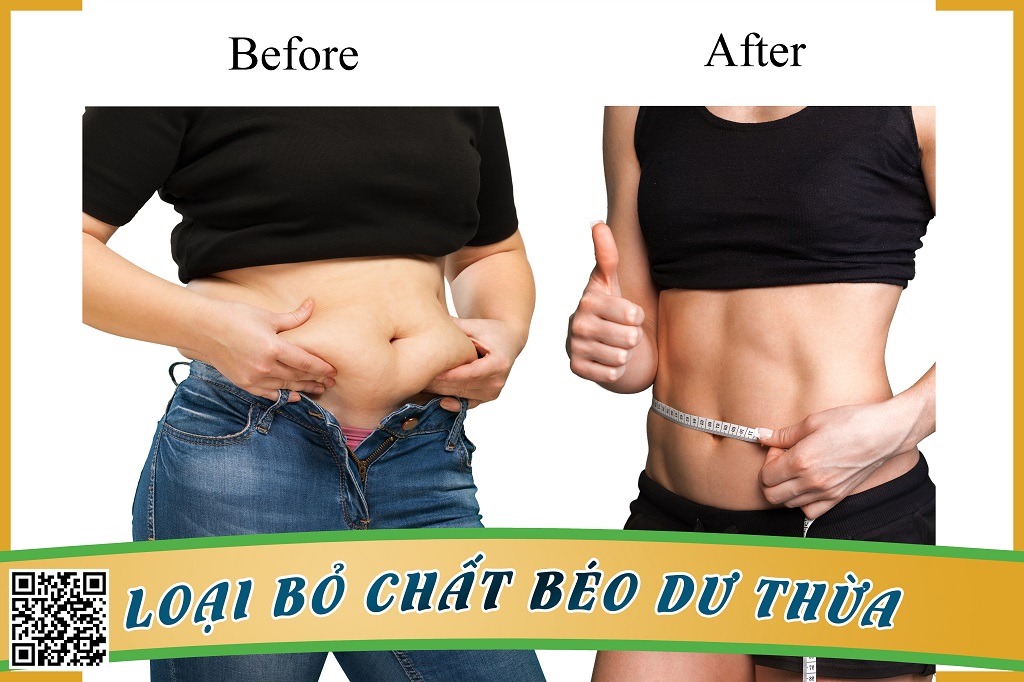 Phẫu Thuật Hút Mỡ Bụng Và 3 Lưu Ý Quan Trọng