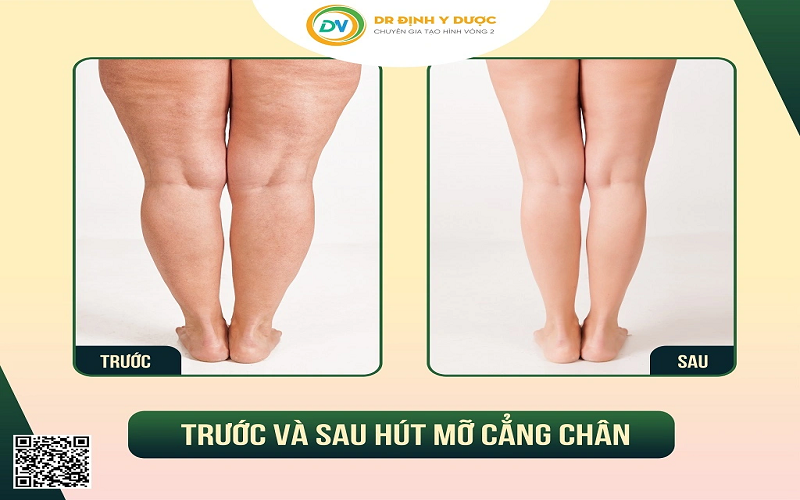 hút mỡ cẳng chân