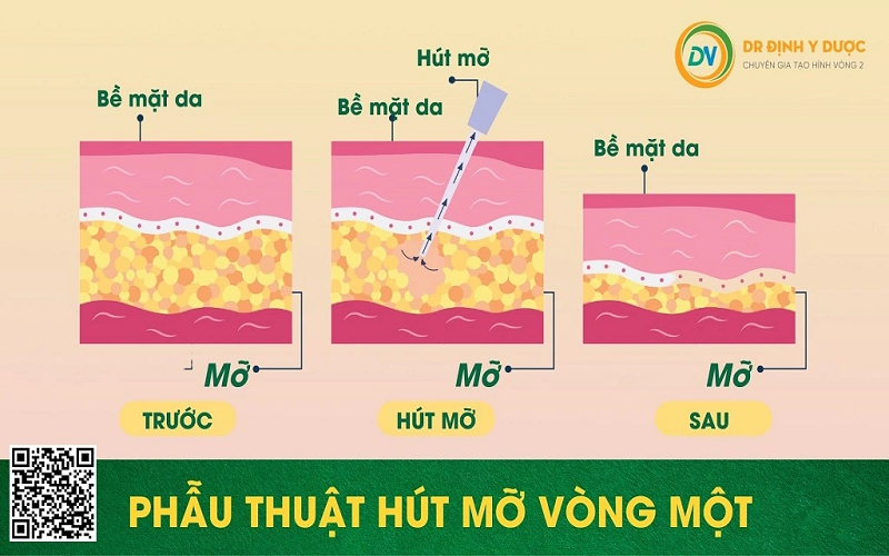 hút mỡ vòng một