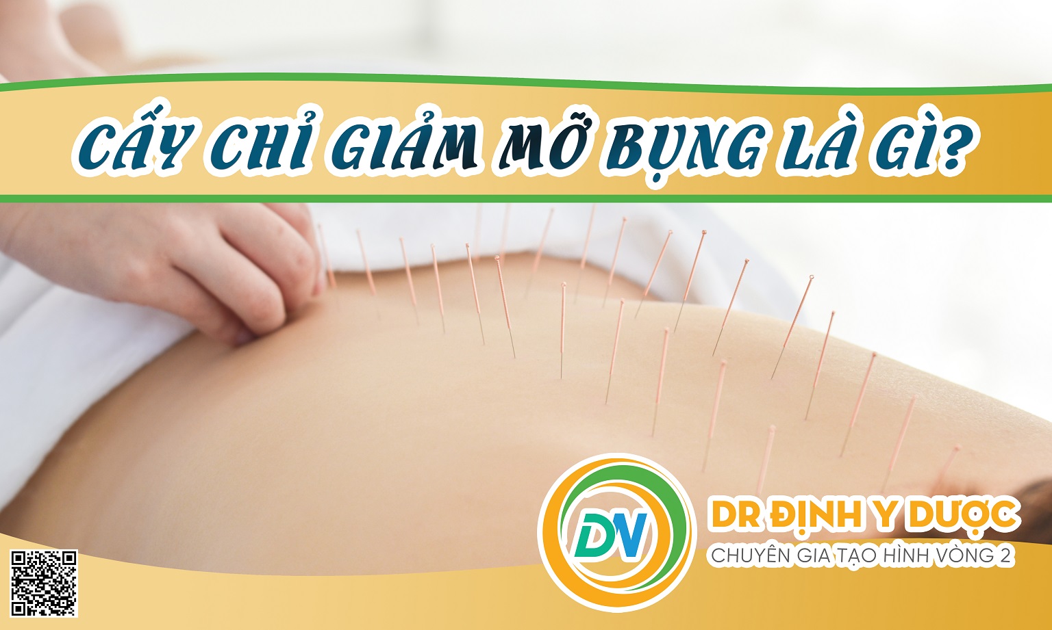 cấy chỉ giảm mỡ bụng