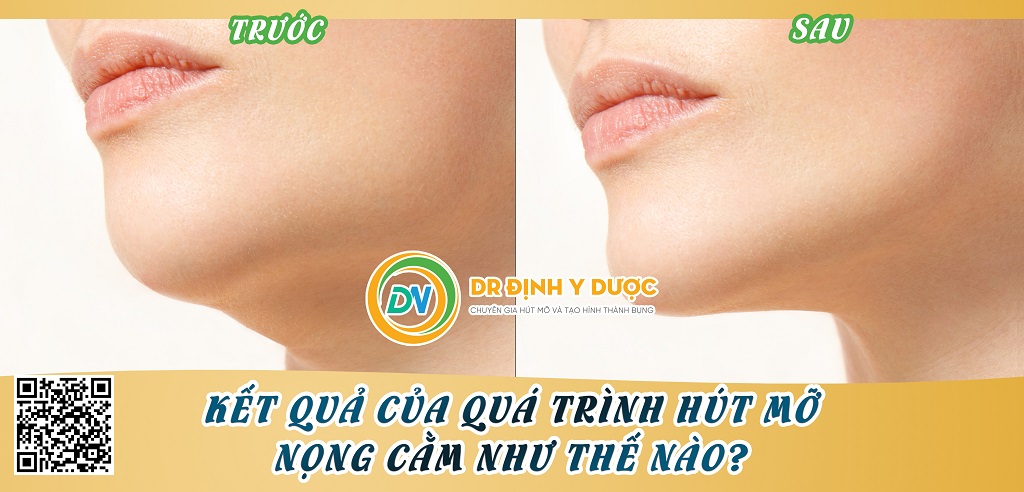 kết quả của quá trình hút mỡ nọng cằm như thế nào?