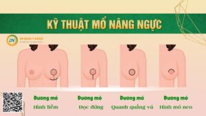 Hút mỡ vòng một