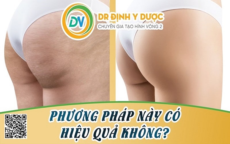 cấy mỡ mông