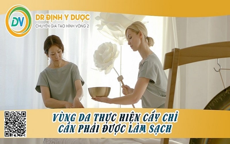 cấy chỉ giảm mỡ bụng