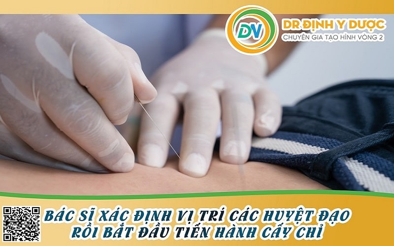 cấy chỉ giảm mỡ bụng