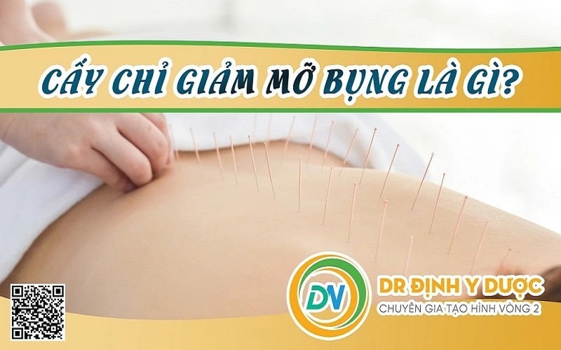 cấy chỉ giảm mỡ bụng