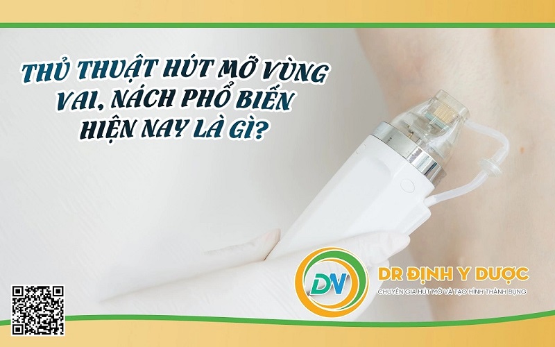 thủ thuật hút mỡ vùng vai và nách phổ biến hiện nay là gì?