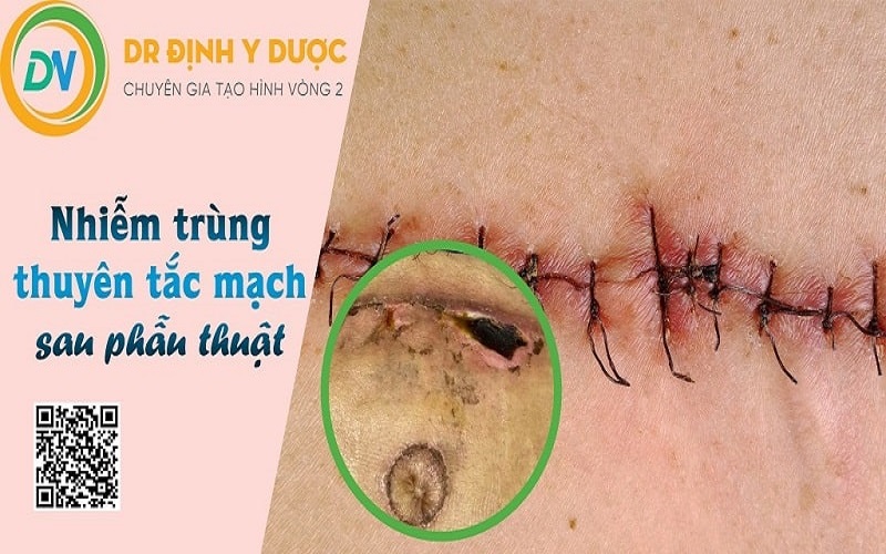 cách hút mỡ bụng tại nhà