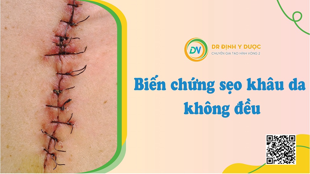 Biến chứng của hút mỡ bắp tay không an toàn