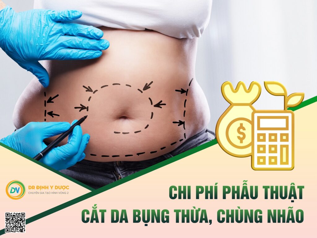 Chi phí phẫu thuật cắt da bụng thừa, chùng nhão