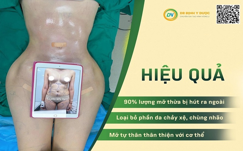 tạo hình thành bụng hút mỡ