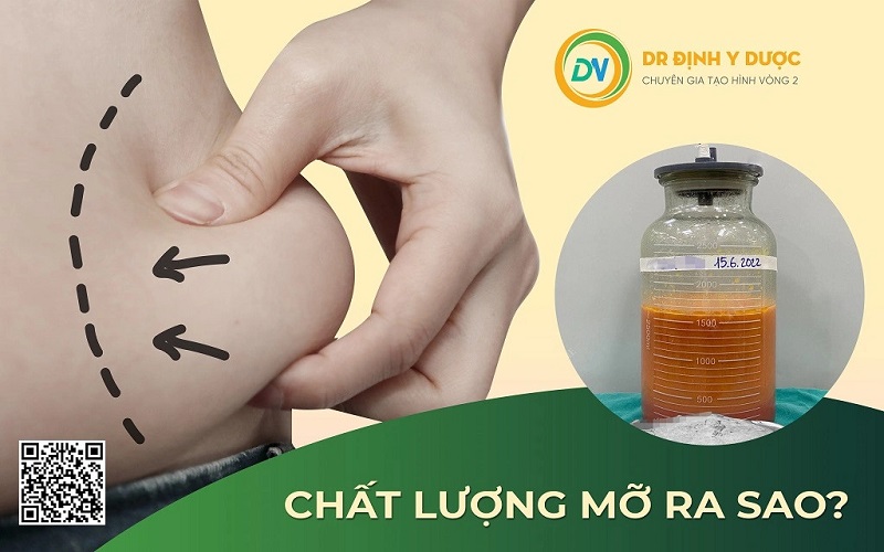 tạo hình thành bụng hút mỡ