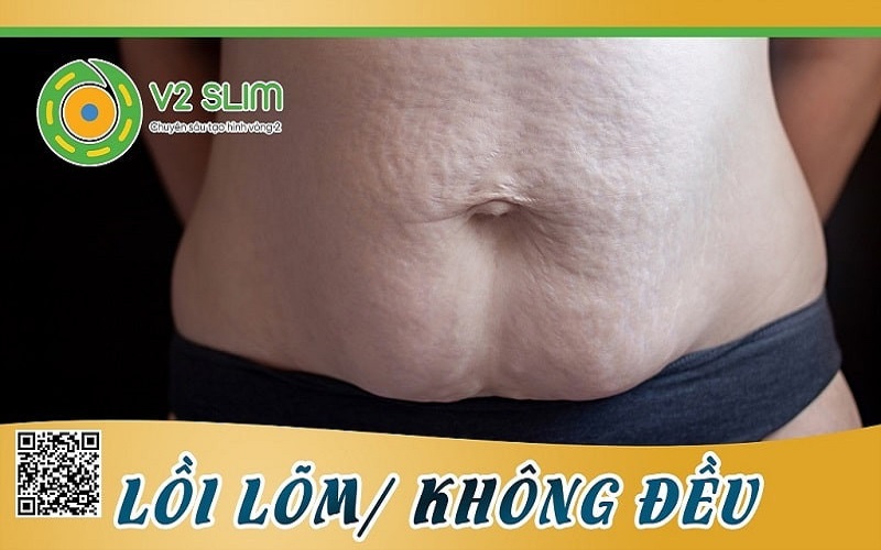 biến chứng hút mỡ bụng