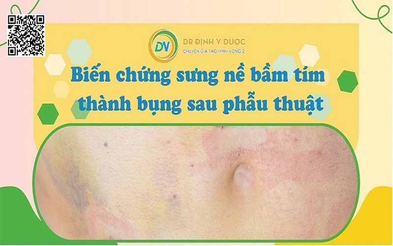 hút mỡ bụng có nguy hiểm ko