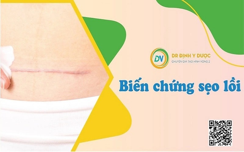 hút mỡ bụng có nguy hiểm ko