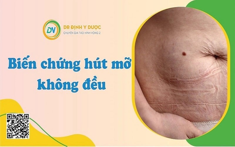 hút mỡ bụng có nguy hiểm ko