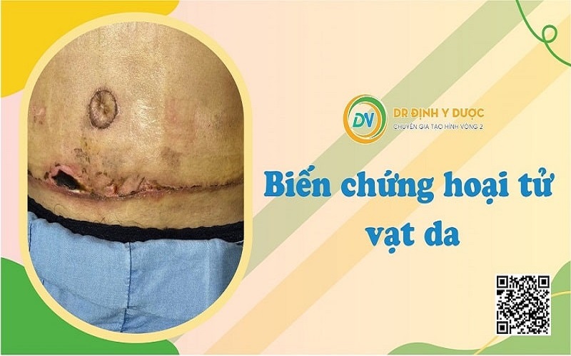 hút mỡ bụng có nguy hiểm ko