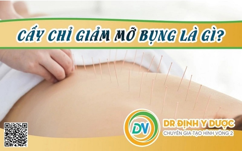 cấy chỉ giảm béo