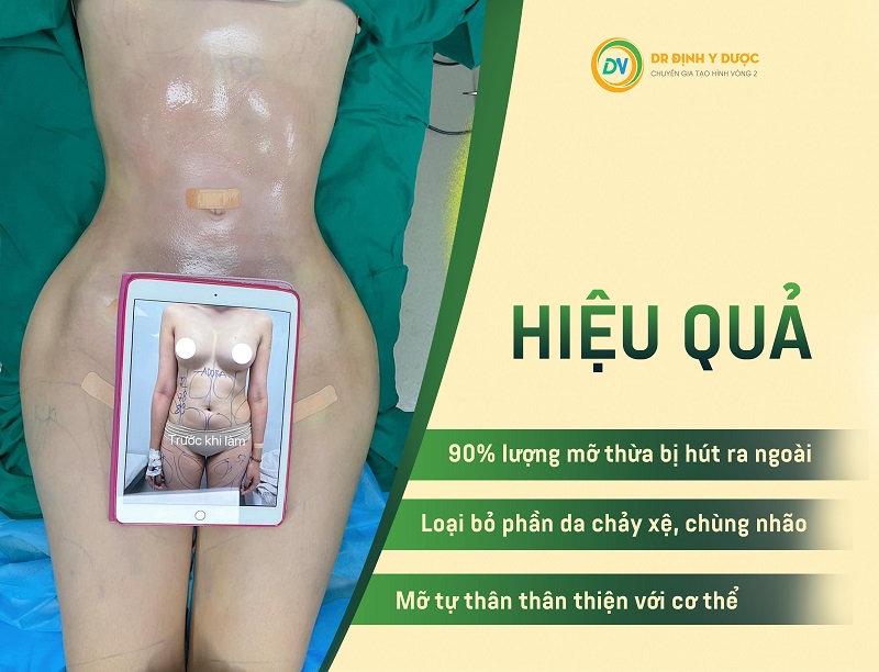 Tạo hình thành bụng hút mỡ