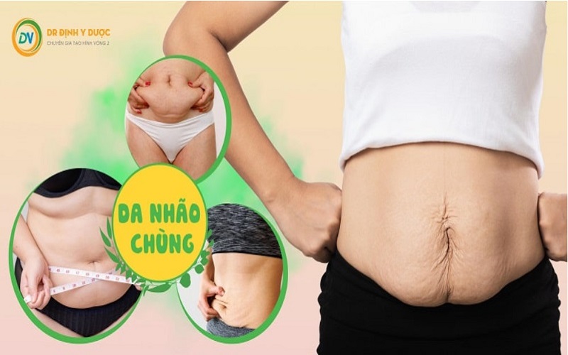 Da bụng bị chùng nhão sau sinh