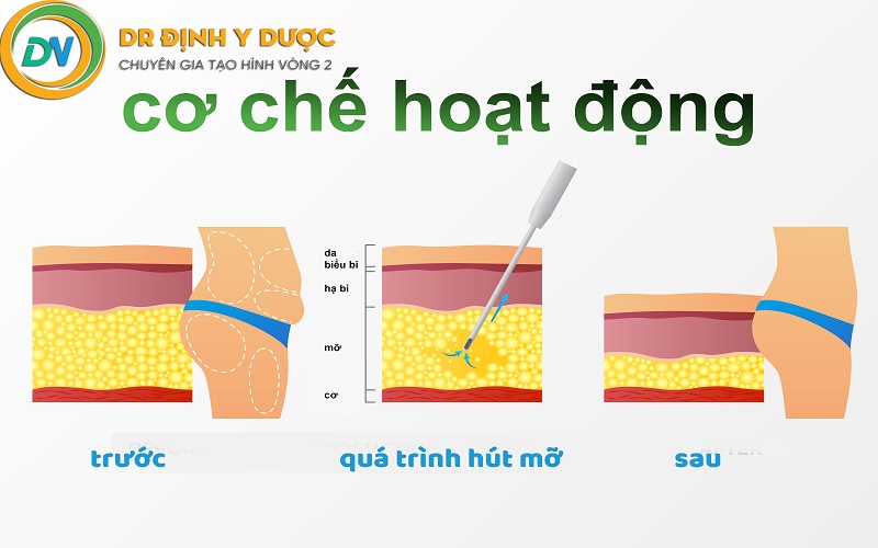 Tác hại của phẫu thuật tạo hình thành bụng