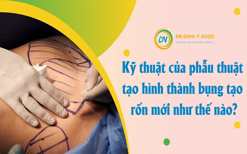 Tạo Hình Thành Bụng Tạo Rốn Mới