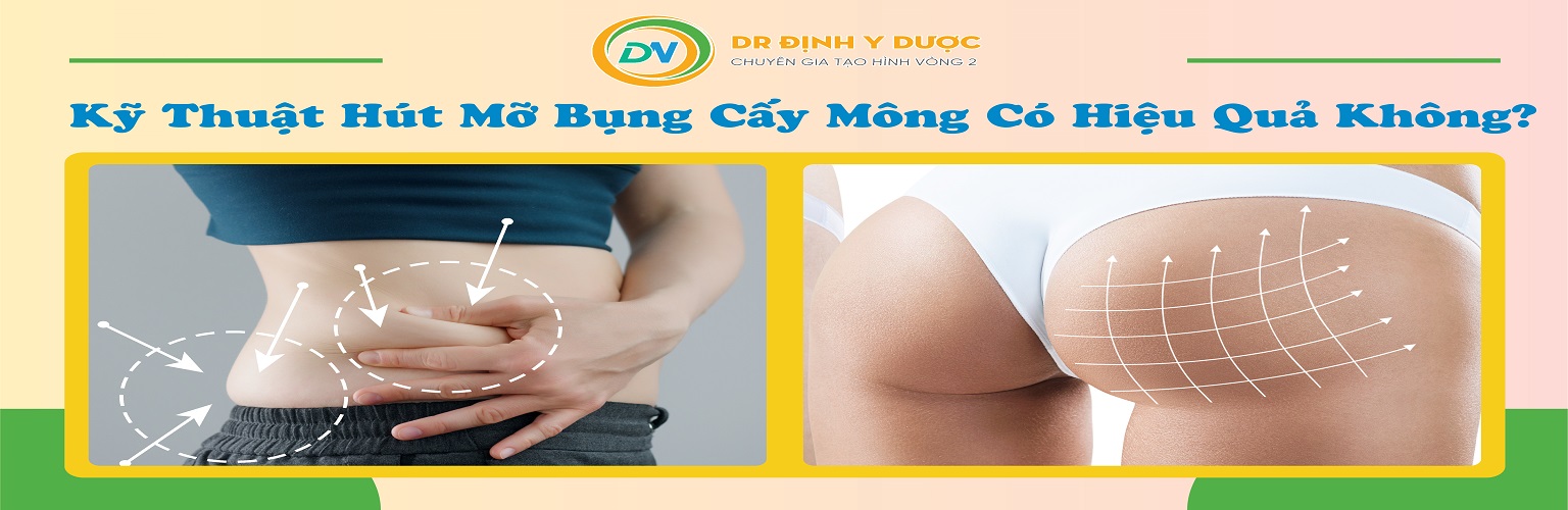 kỹ thuật hút mỡ bụng