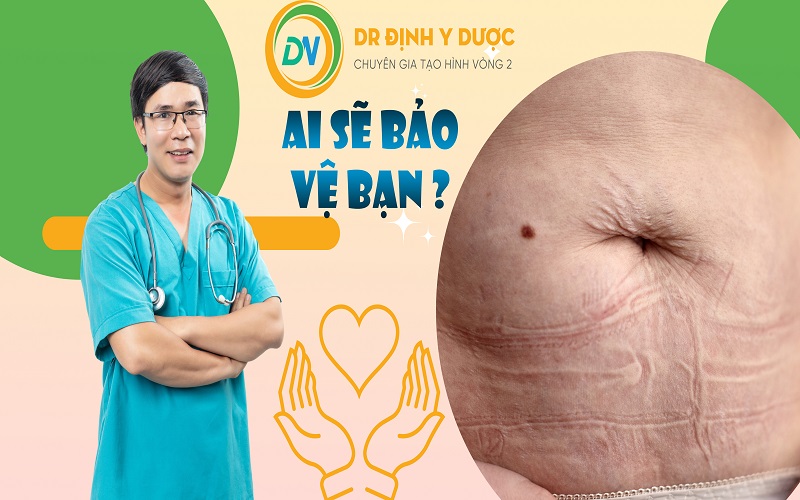 kỹ thuật hút mỡ bụng