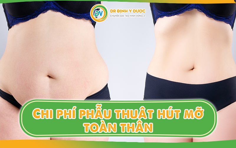 Chi phí phẫu thuật hút mỡ toàn thân