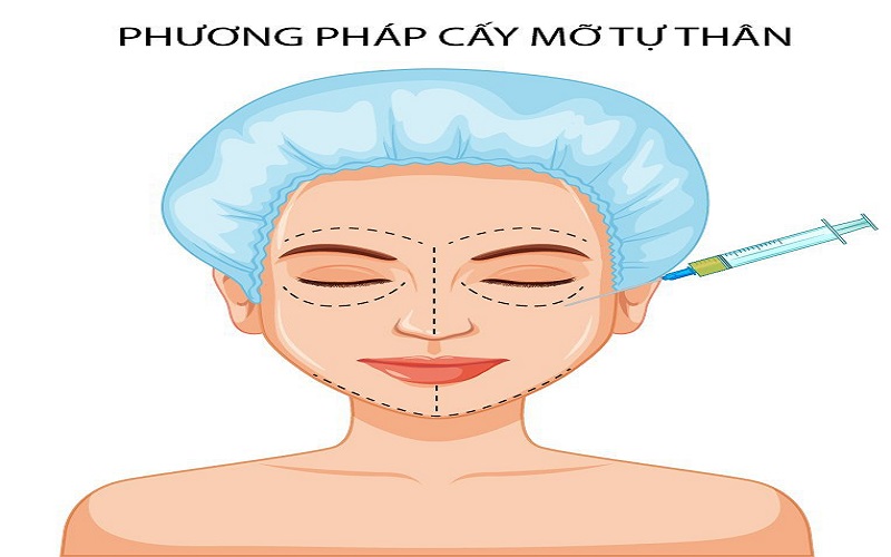 phương pháp cấy mỡ tự thân ảnh hưởng đến bảng giá cấy mỡ tự thân lên mặt