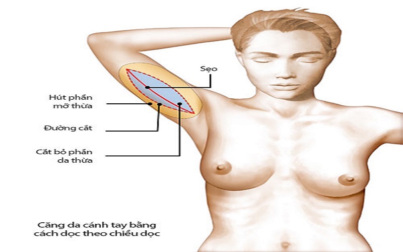 Giá hút mỡ bắp tay