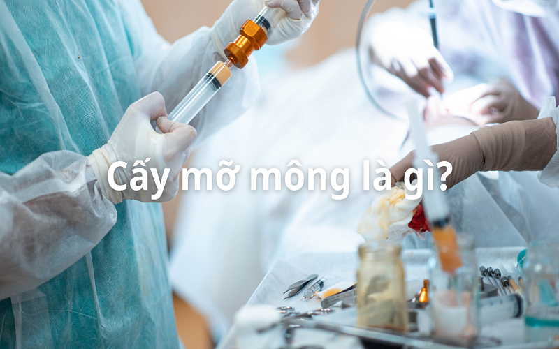 cấy mỡ mông là gì