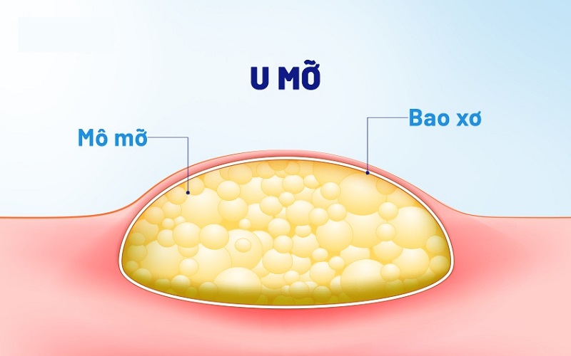 U mỡ là gì