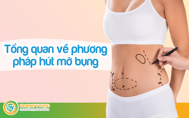 Tổng quan về phương pháp hút mỡ bụng