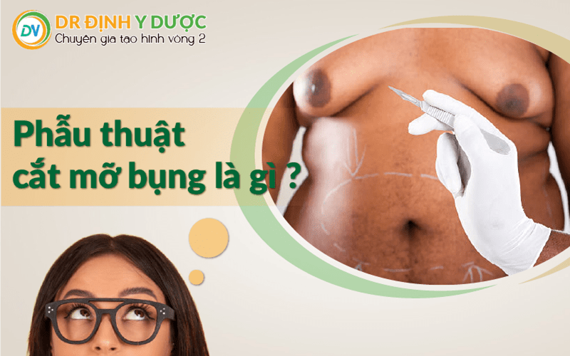 phẫu thuật cắt mỡ bụng