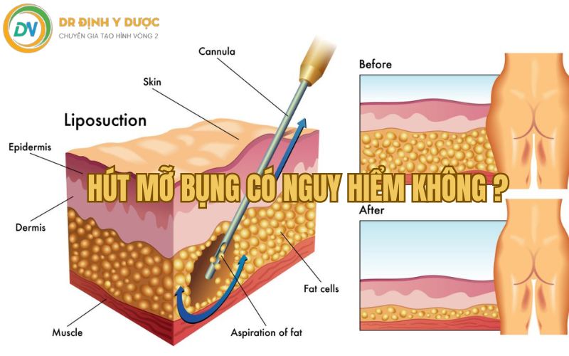 hút mỡ bụng có nguy hiểm không