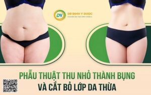 phẫu thuật cắt da thừa ở bụng