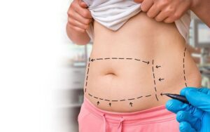 Gầy Nhưng Bụng To Nguyên Nhân Do Đâu - Liệu Có Nên Hút Mỡ Bụng Cho Người Gầy Không?
