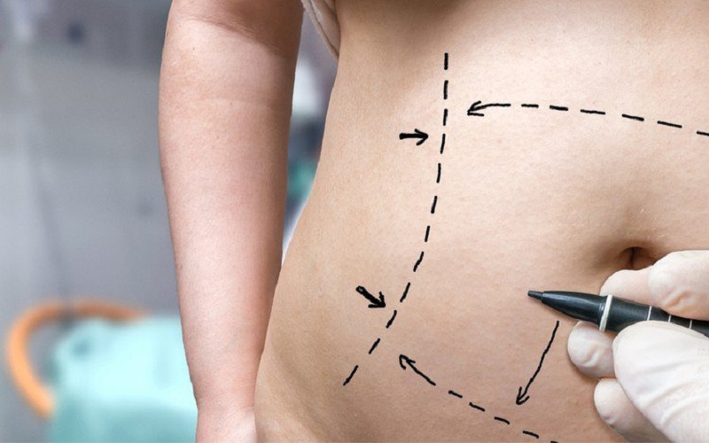 Tại sao nên lựa chọn phẫu thuật cắt mỡ tạo hình thành bụng