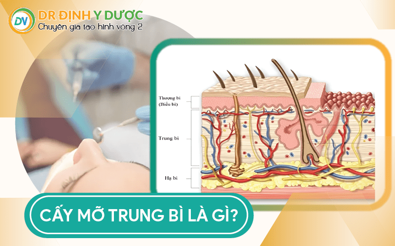 cấy mỡ trung bì vào mũi là gì