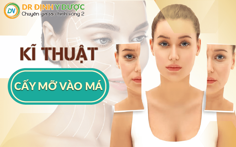 kĩ thuật cấy mỡ vào má