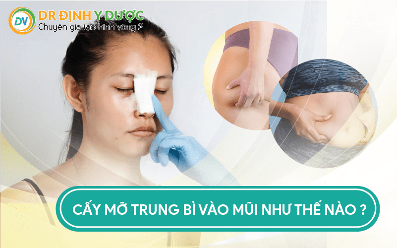 cấy mỡ trung bì vào mũi như thế nào?