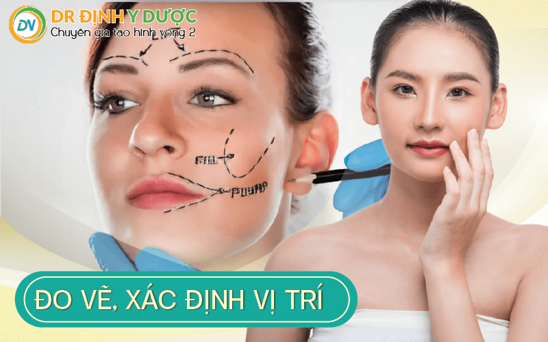 đo vẽ xác định vị trí cấy mỡ tự thân vào má