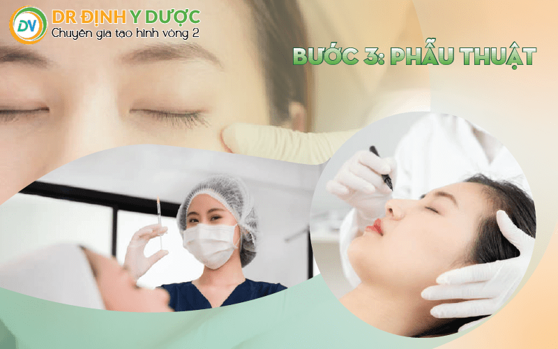 bước 3: phẫu thuật cấy mỡ tự thân